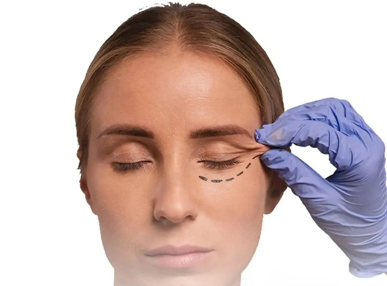 تجميل الجفون السفلية — حالة 5 — د. حسام الباز