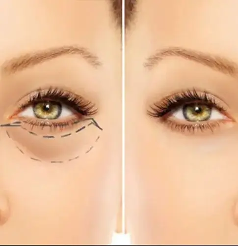 تجميل الجفون السفلية — حالة 6 — د. حسام الباز