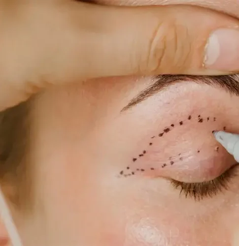 تجميل الجفون العلوية — حالة 1 — د. حسام الباز