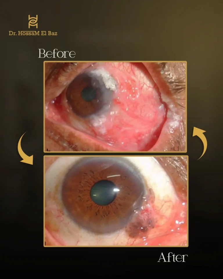 صور قبل وبعد جراحات تجميل الجفون — حالة 11 — د. حسام الباز