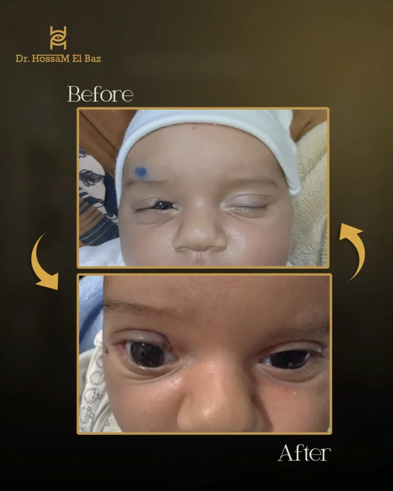 صور قبل وبعد جراحات تجميل الجفون — حالة 16 — د. حسام الباز