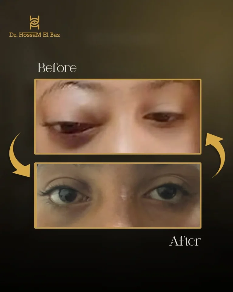 صور قبل وبعد جراحات تجميل الجفون — حالة 22 — د. حسام الباز