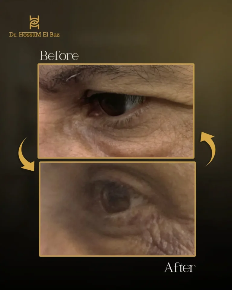صور قبل وبعد جراحات تجميل الجفون — حالة 10 — د. حسام الباز