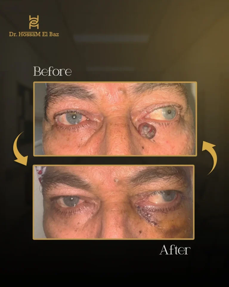 صور قبل وبعد جراحات تجميل الجفون — حالة 33 — د. حسام الباز